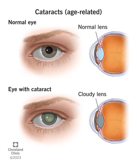 cateract eye drops 1990s testing|can eye drops cause cataracts.